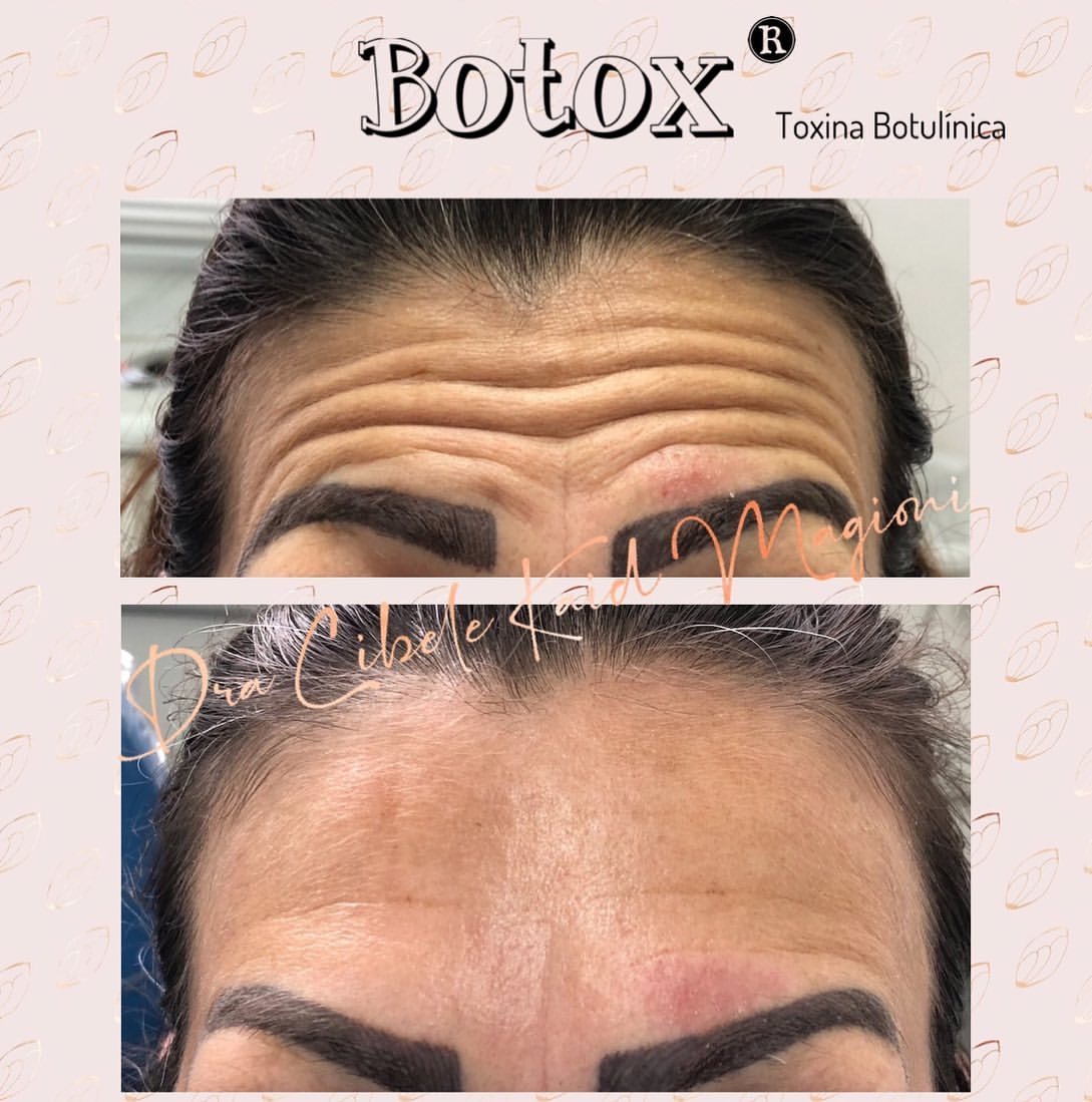 Suavização de Expressão com Botox (antes e depois)